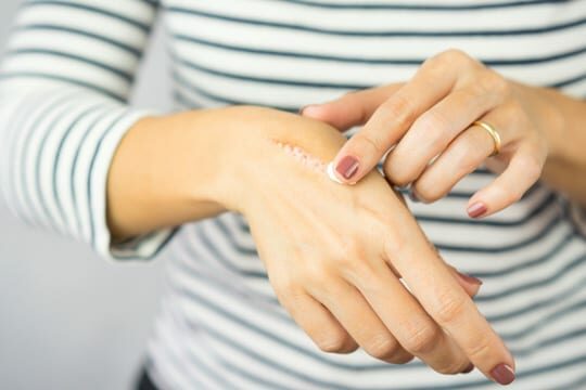Alhydran Littekencrème kopen | Verzacht & herstelt littekens